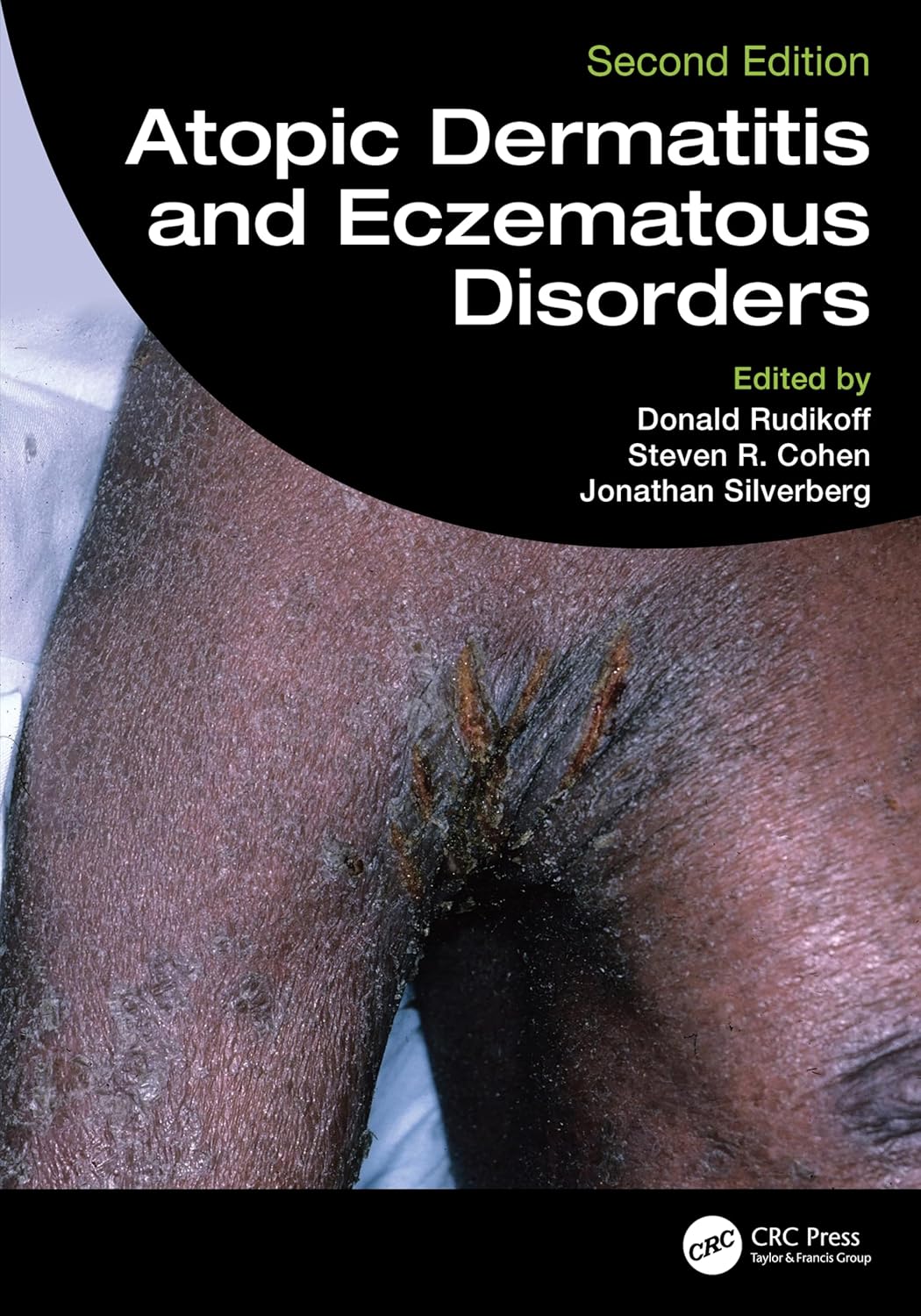 Atopic Dermatitis And Eczematous Disorders 2Ed (Hb 2026)