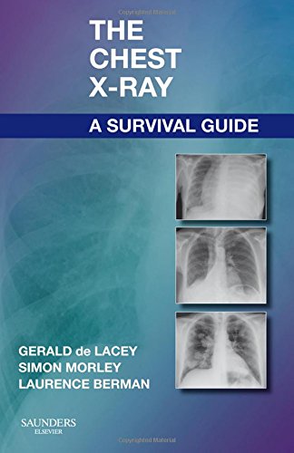 Chest X-Ray : A Survival Guide