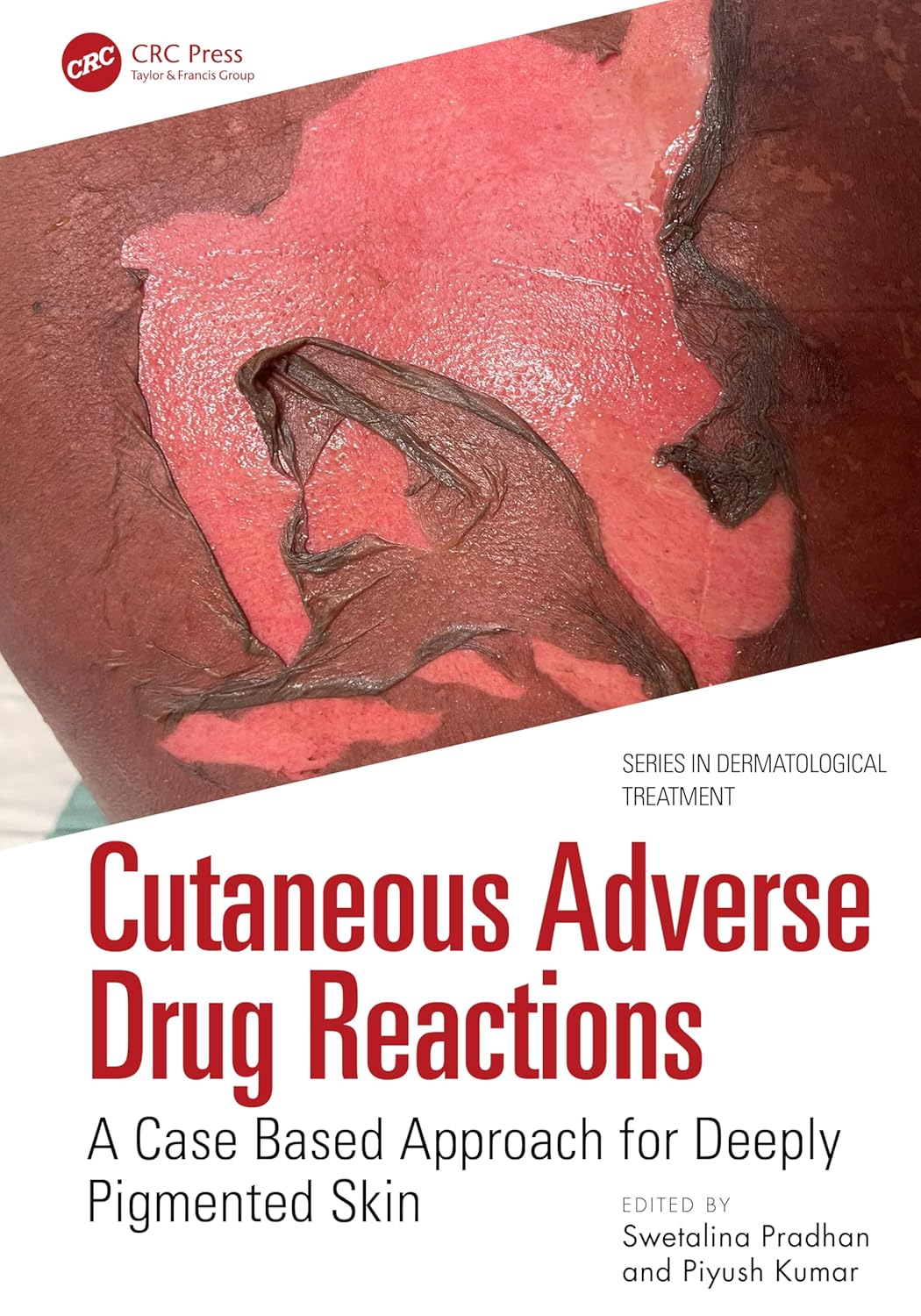Cutaneous Adverse Drug Reactions A Case Based Approach For Deeply Pigmented Skin (Pb 2026)
