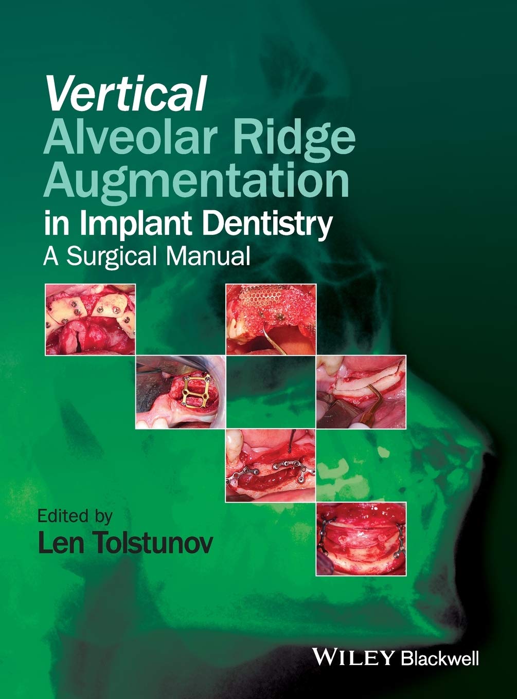 Vertical Alveolar Ridge Augmentation Of The Alveolar Ridge In Implant Dentistry