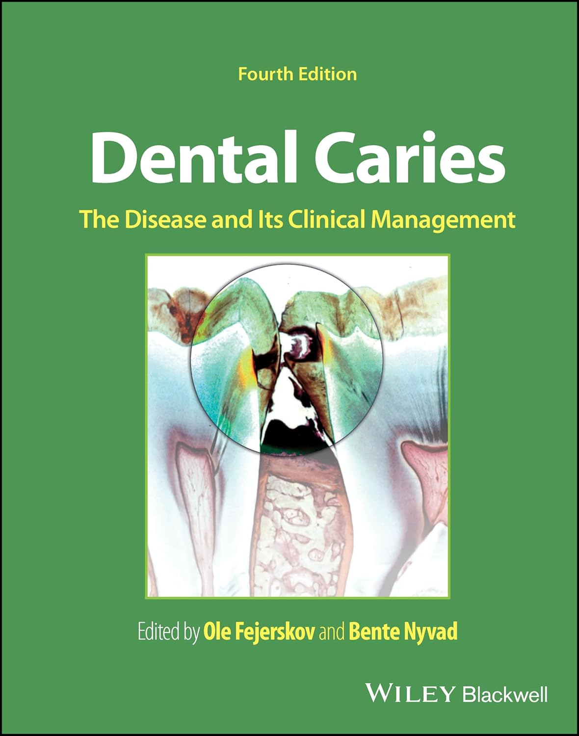 Dental Caries The Disease And Its Clinical Management 4Ed (Hb 2025)