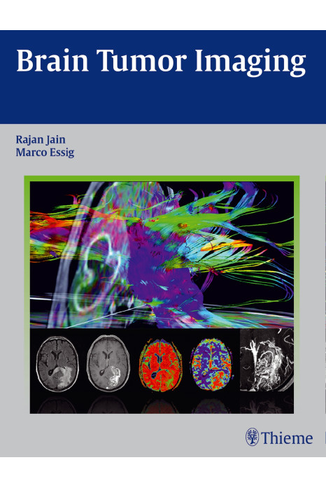 Brain Tumor Imaging 1st Ed.