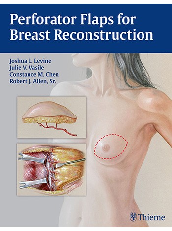 Perforator Flaps for Breast Reconstruction: 1/e