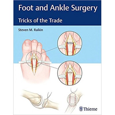 Foot And Ankle Surgery: Tricks Of The Trade 1 Edition