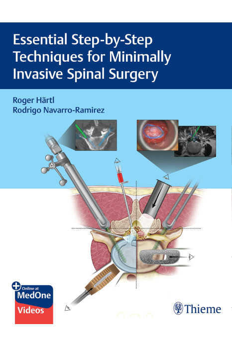 Essential Step-by-Step Techniques for Minimally Invasive Spinal Surgery 1st Ed.