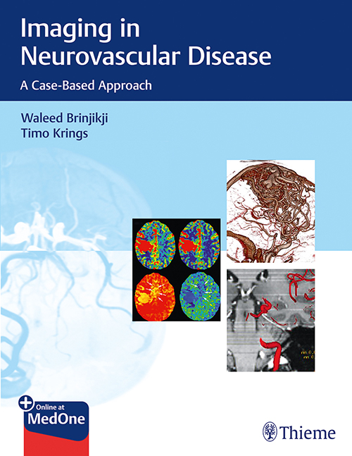 Imaging In Neurovascular Disease: 1/E
