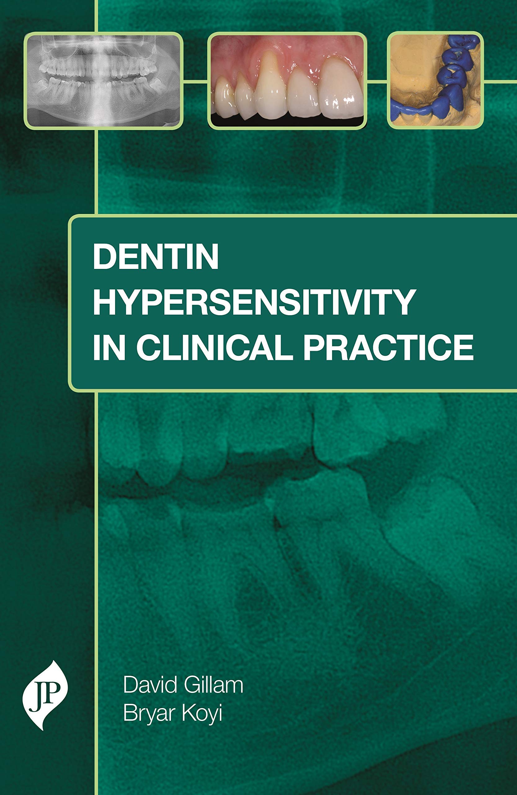 Dentin Hypersensitivity In Clinical Practice