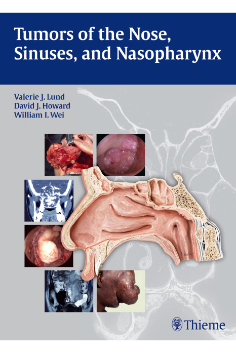 Tumors of The Nose , Sinuses, and Nasopharynx