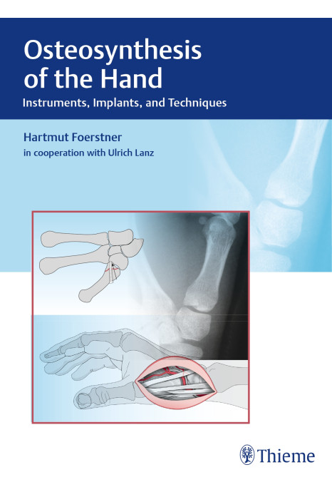 Osteosynthesis of the Hand : Instruments, Implants, and Techniques 1st Edition