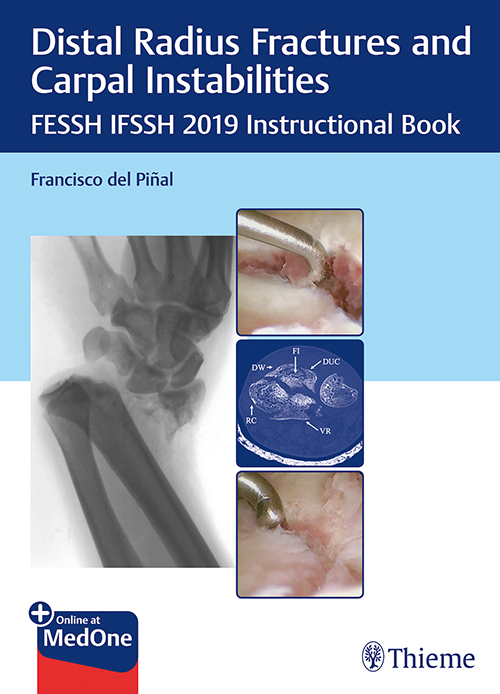 Distal Radius Fractures And Carpal Instabilities: 1/E