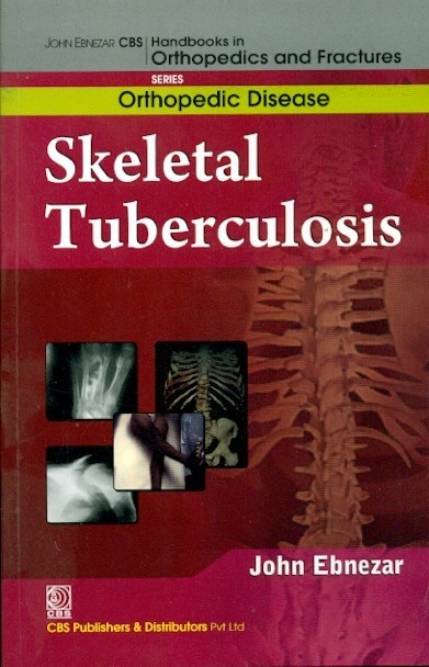Skeletal Tuberculosis (Handbooks In Orthopedics And Fractures Series Vol 33 Orthopedic Diseases (2012)