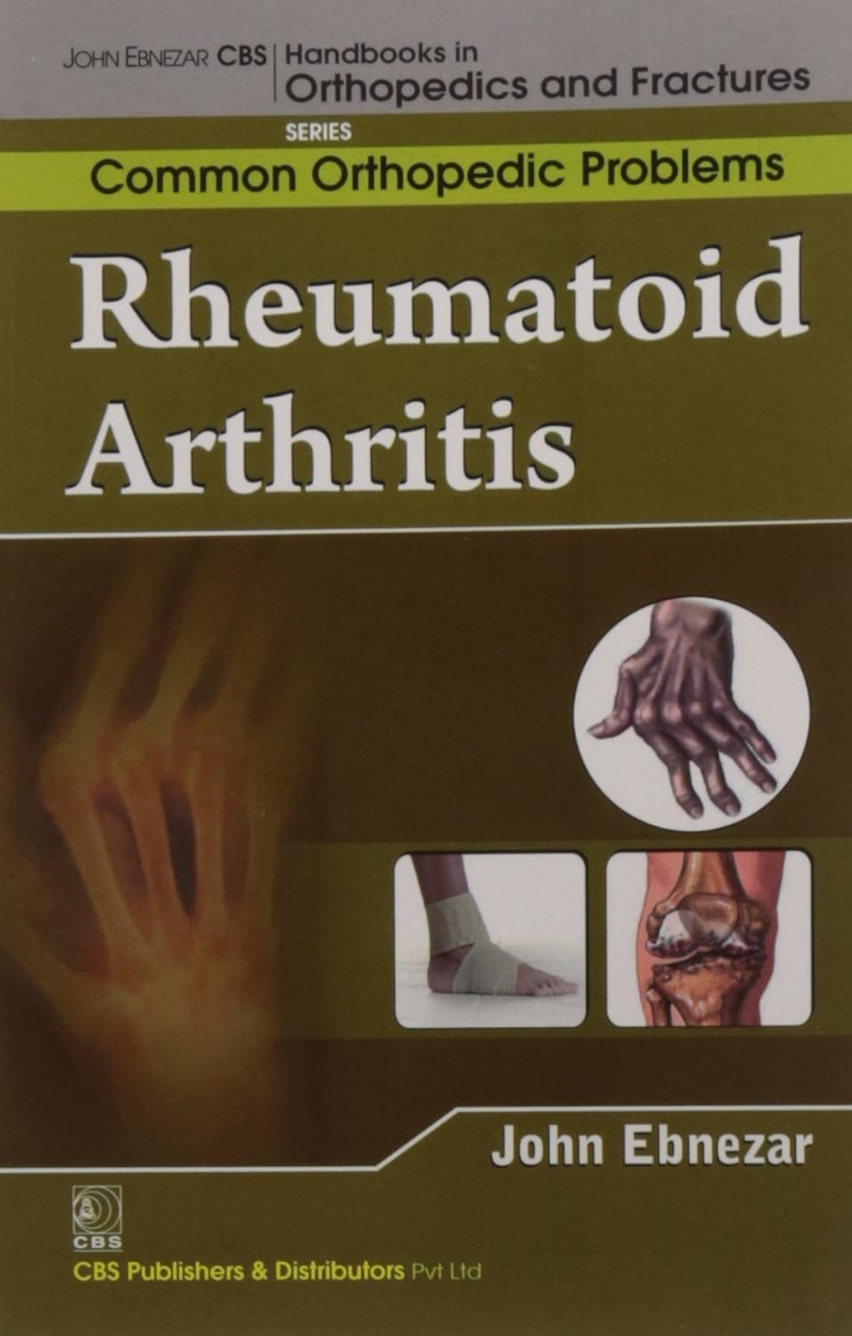 Rheumatoid Arthritis (Handbooks In Orthopedics And Fractures Series Vol 92 Common Orthopedic Problems (2012)