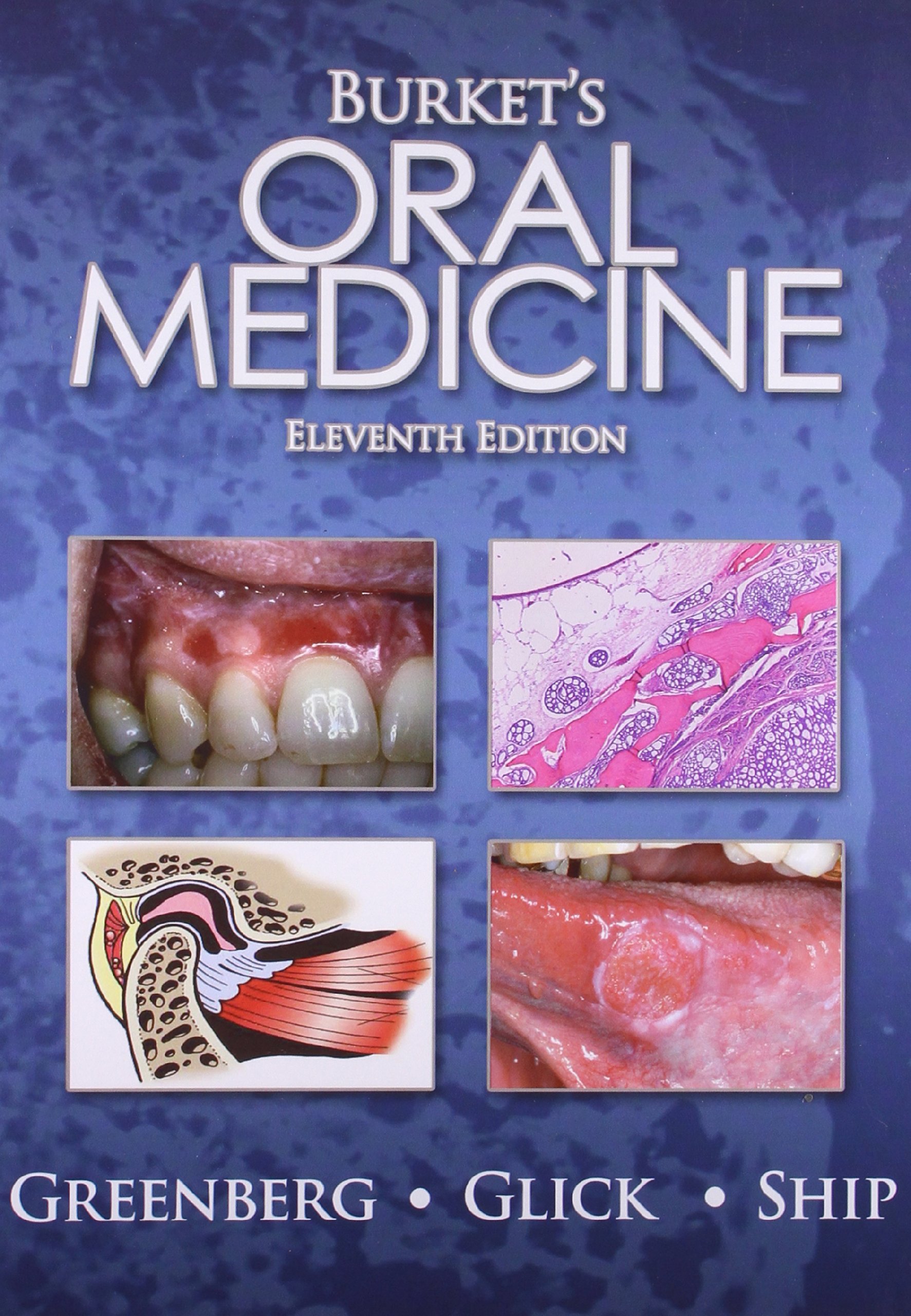 Burket'S Oral Medicine, 11E- (OLD Edition)