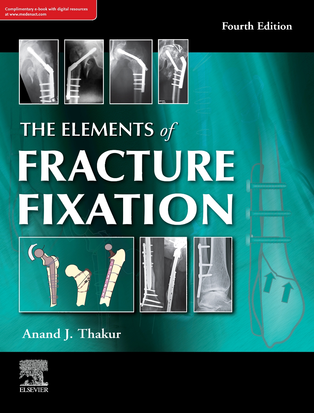 The Elements Of Fracture Fixation, 4E (Old Edition)