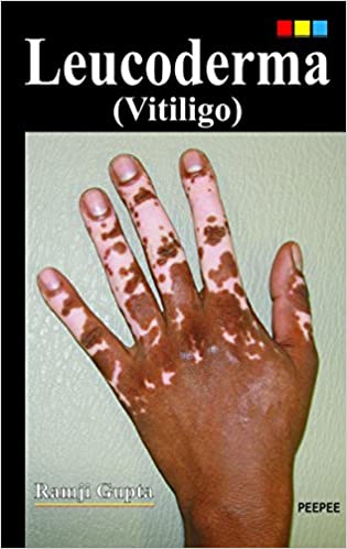 Leucoderma (Vitiligo)