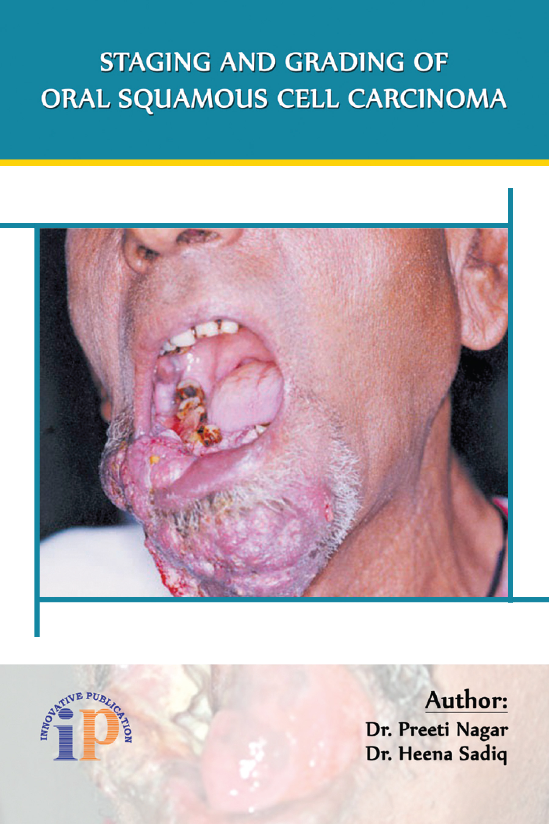 Staging And Grading Of Oral Squamous Cell Carcinoma