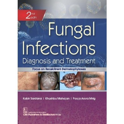 Fungal Infections, 2E Diagnosis And Treatment