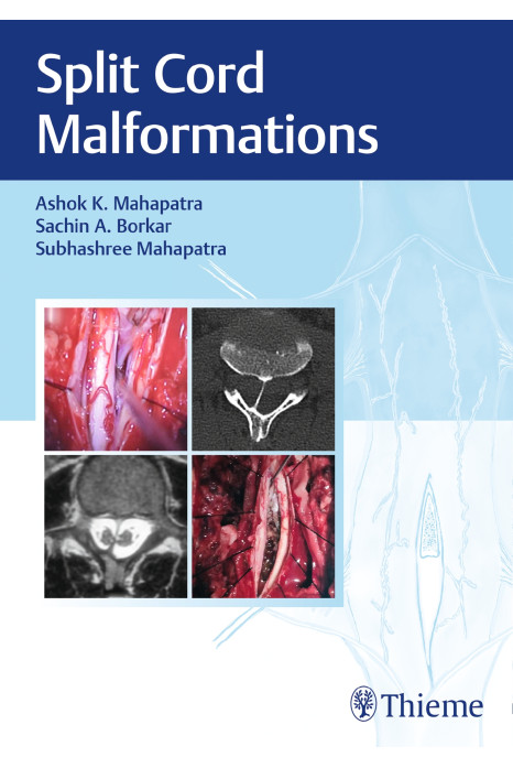 Split Cord Malformations 1st Ed.