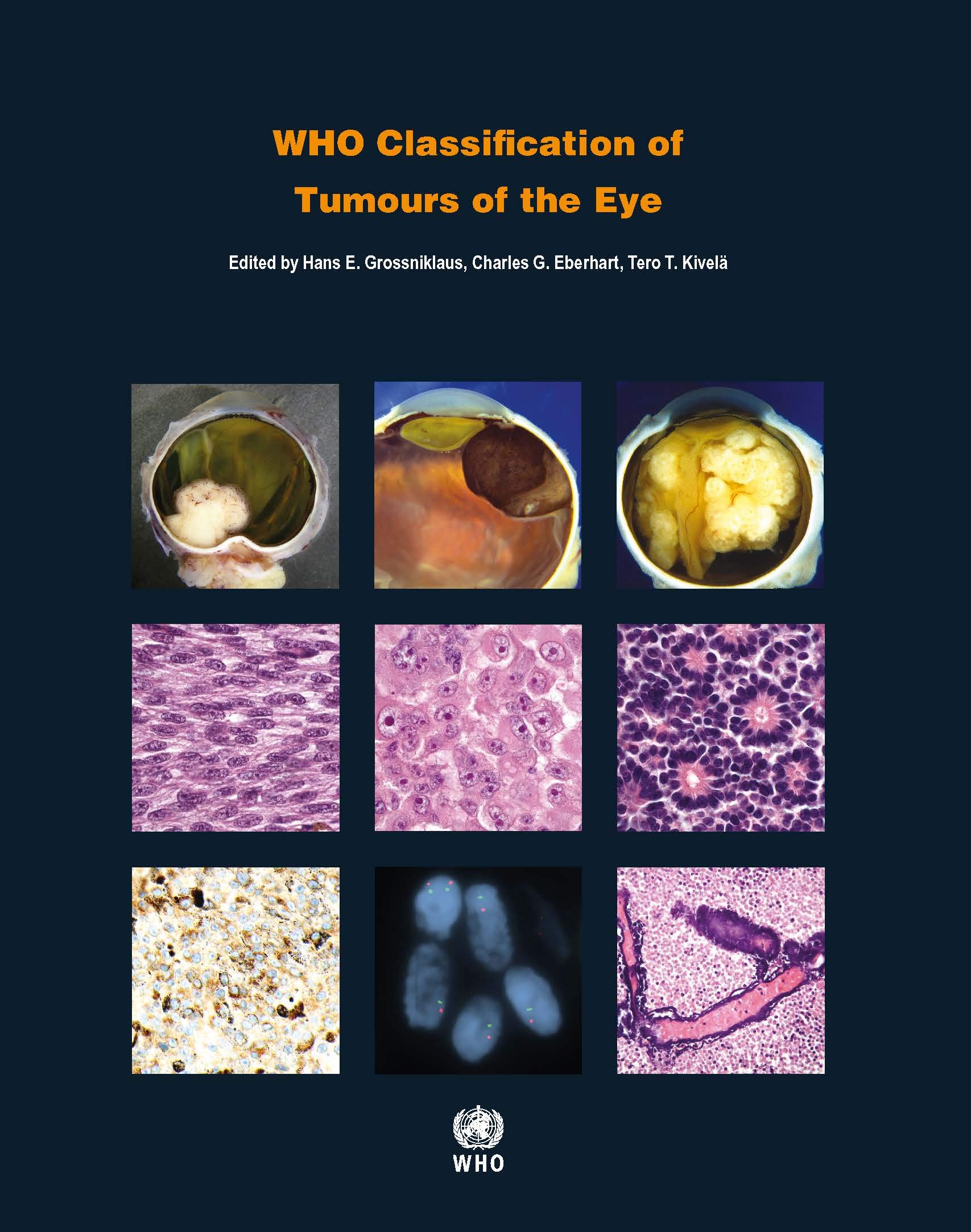 WHO Classification Of Tumours Of Eye