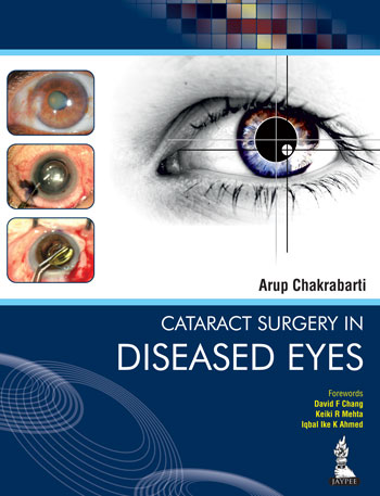 Cataract Surgery In Diseased Eyes