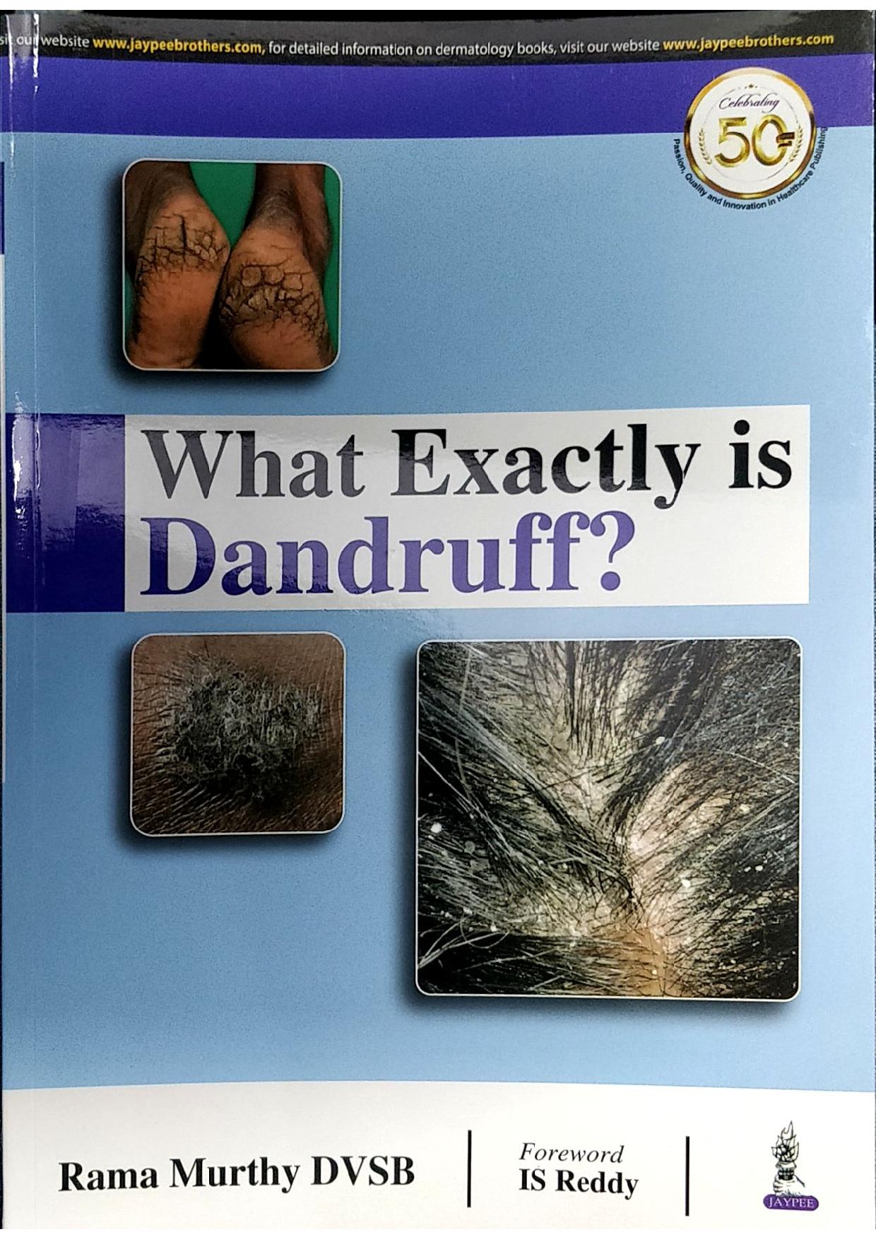 What Exactly Is Dandruff ?
