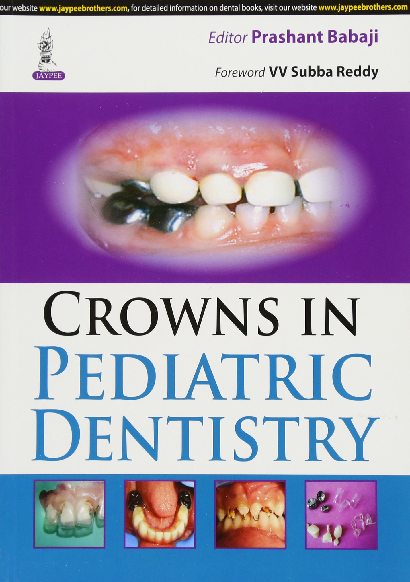 Crowns In Pediatric Dentistry