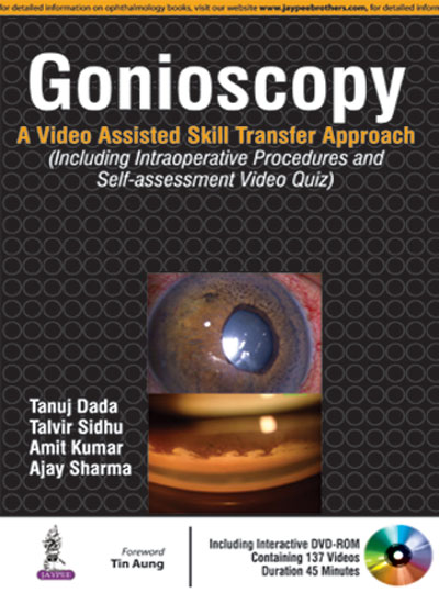 Gonioscopy:A Video Assisted Skill Transfer Approach With Dvd-Rom