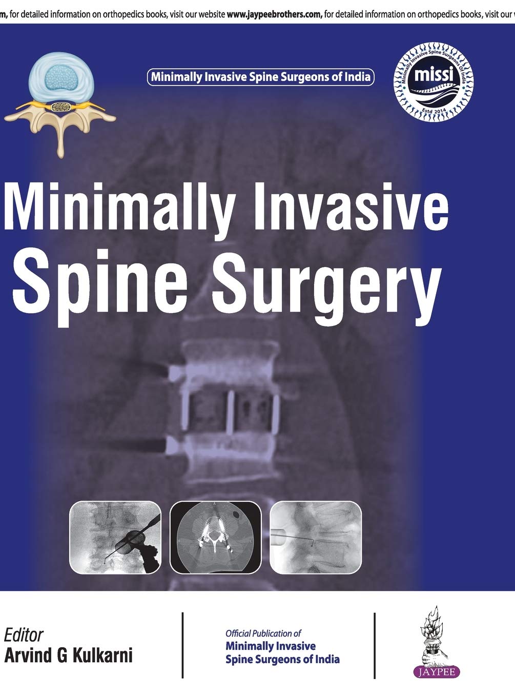 Minimally Invasive Spine Surgery(Official Publication Of Minimally Invasive Spine Surgeons Of India)
