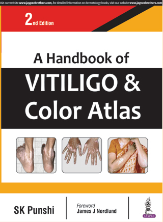 A Handbook Of Vitiligo & Color Atlas
