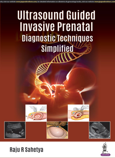 Ultrasound Guided Invasive Prenatal Diagnostic Techniques Simplified