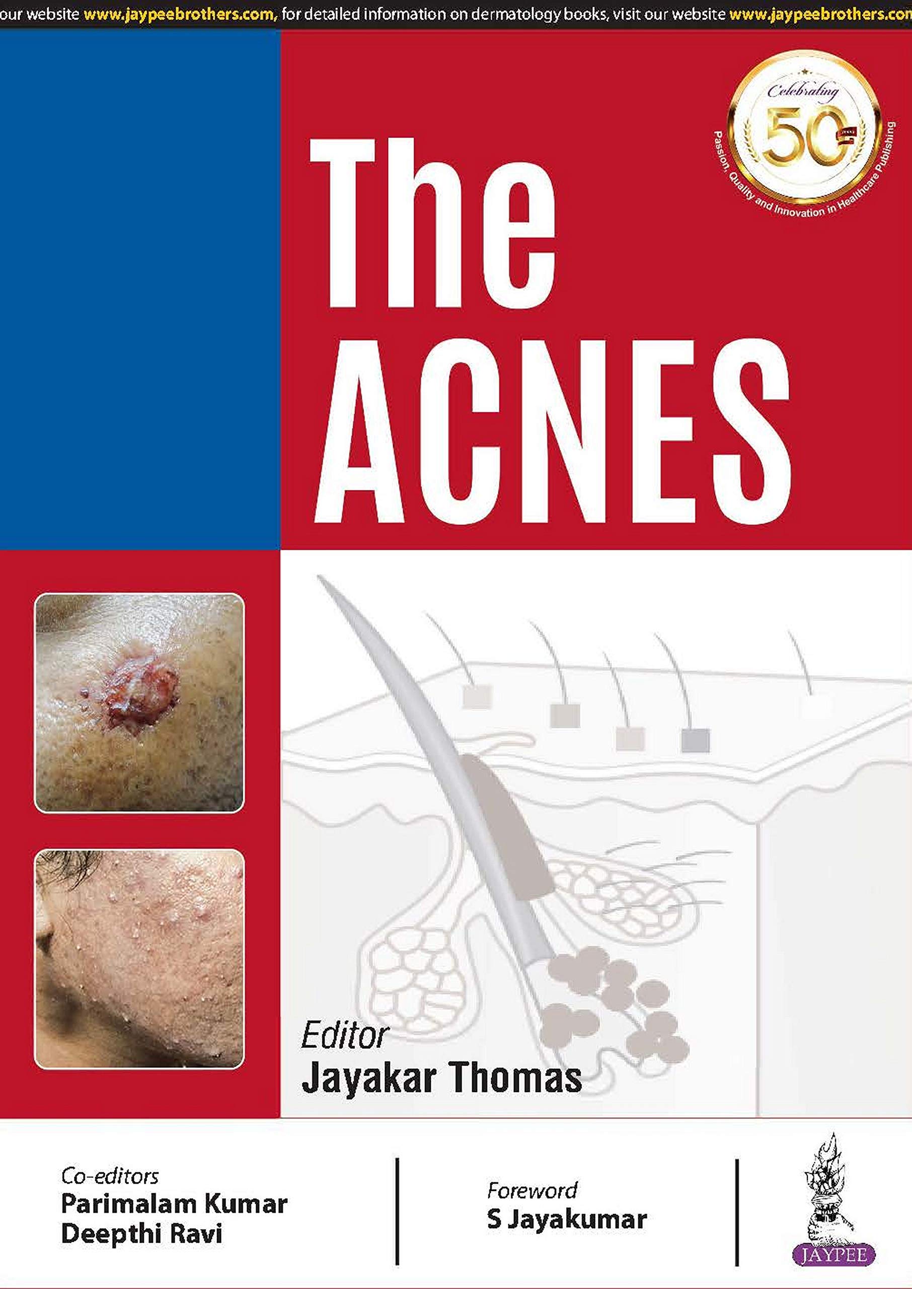 The Acnes