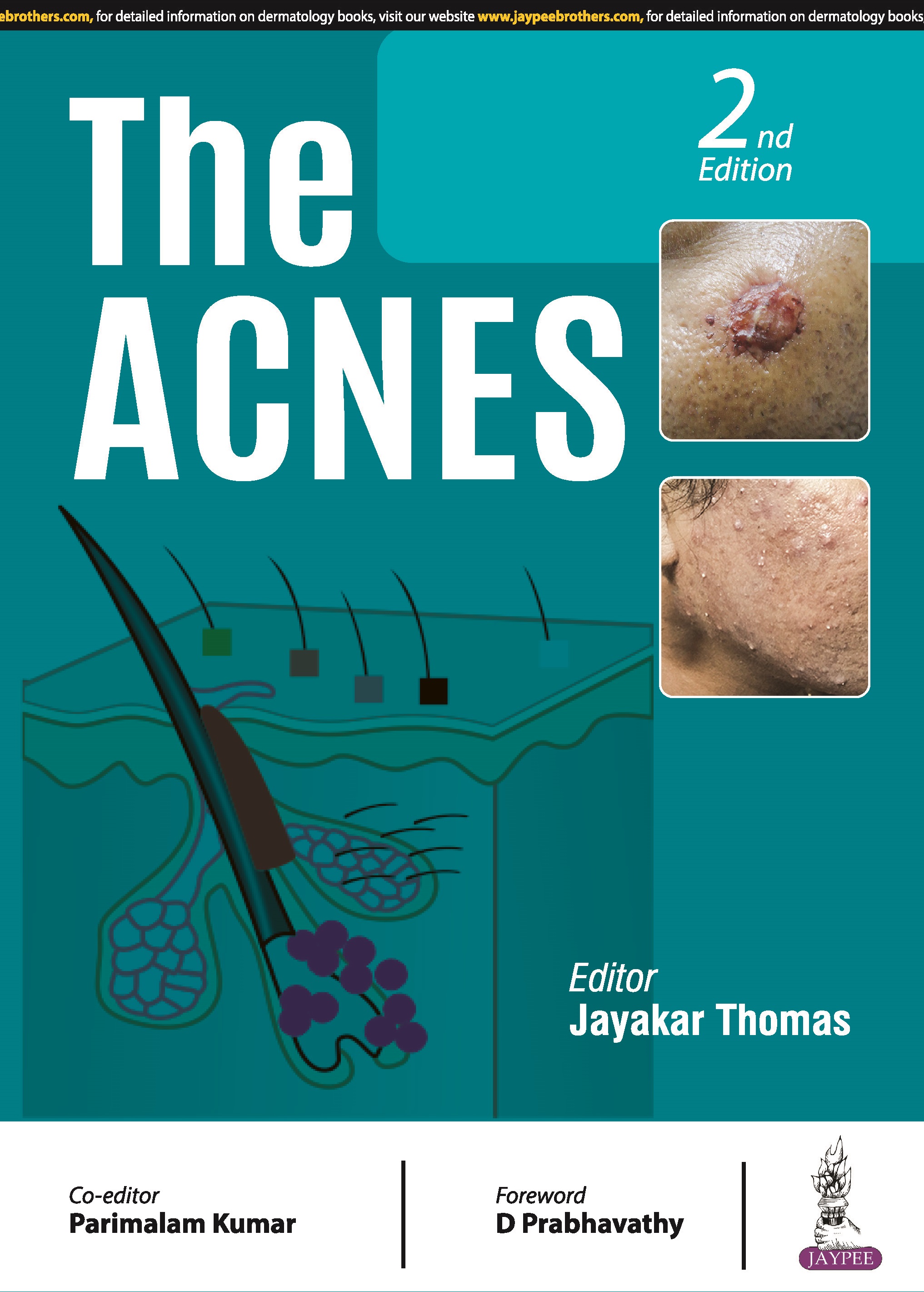 The Acnes  2nd Edition 2024