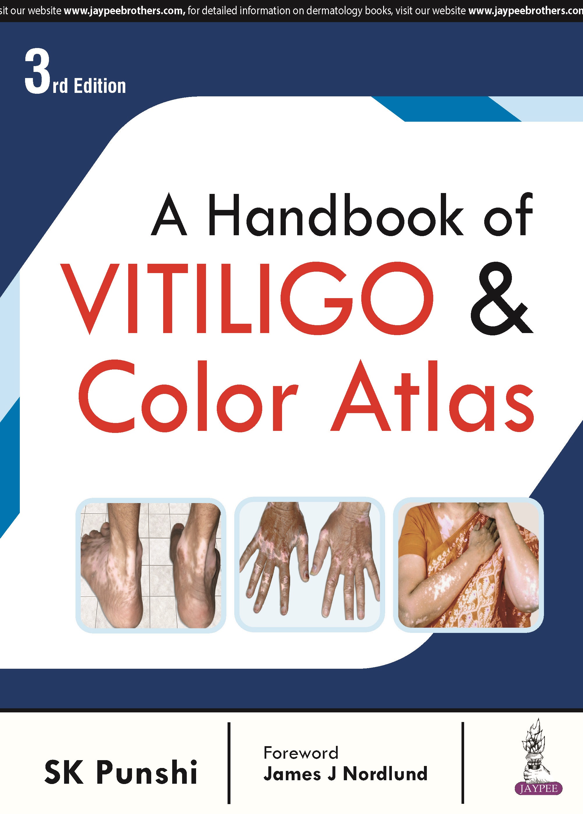 A Handbook of Vitiligo & Color Atlas 3rd Edition