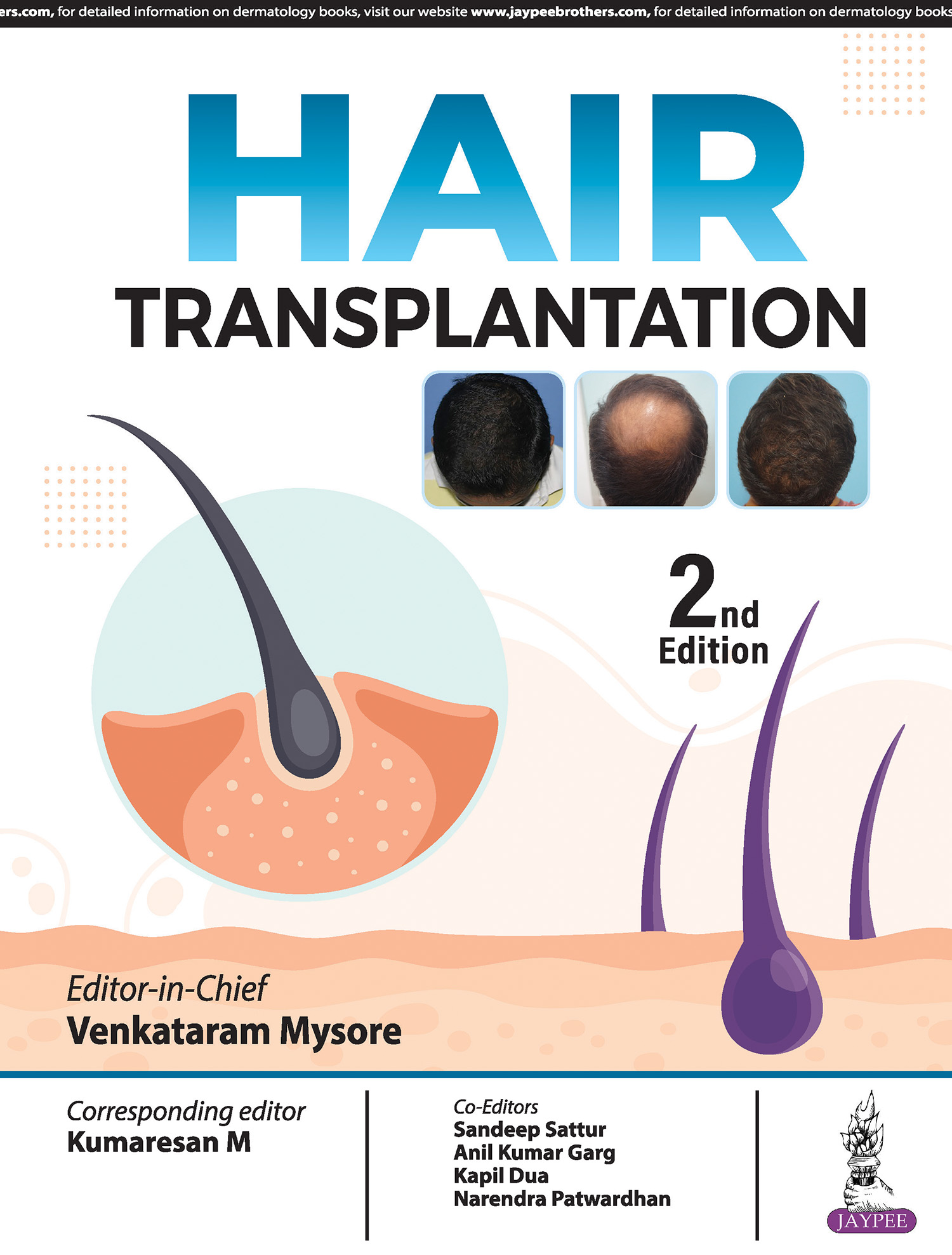 Hair Transplantation 2nd Edition 2024