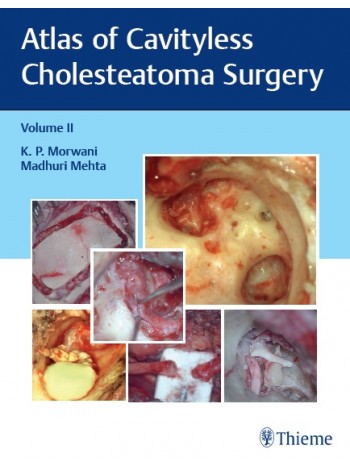 Atlas Of Cavityless Cholesteatoma Surgery: Volume Ii