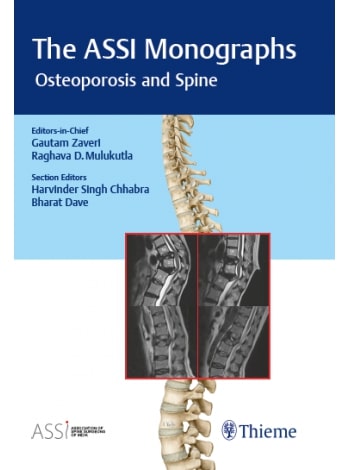 The ASSI Monographs: Osteoporosis and Spine: 1/e