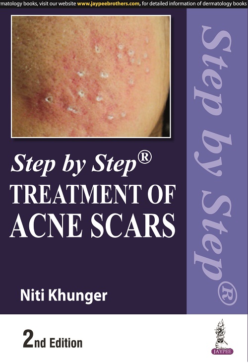 Step by Step Treatment of Acne Scars 2nd 2022