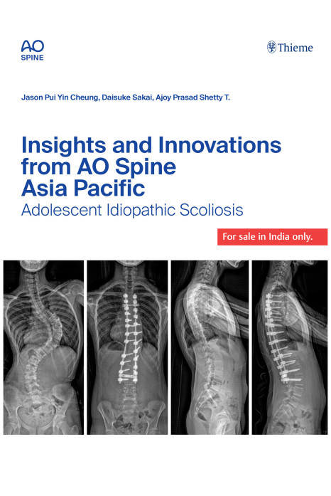 Insights and Innovations from AO Spine Asia Pacific : Adolescent Idiopathic Scoliosis 1st Edition