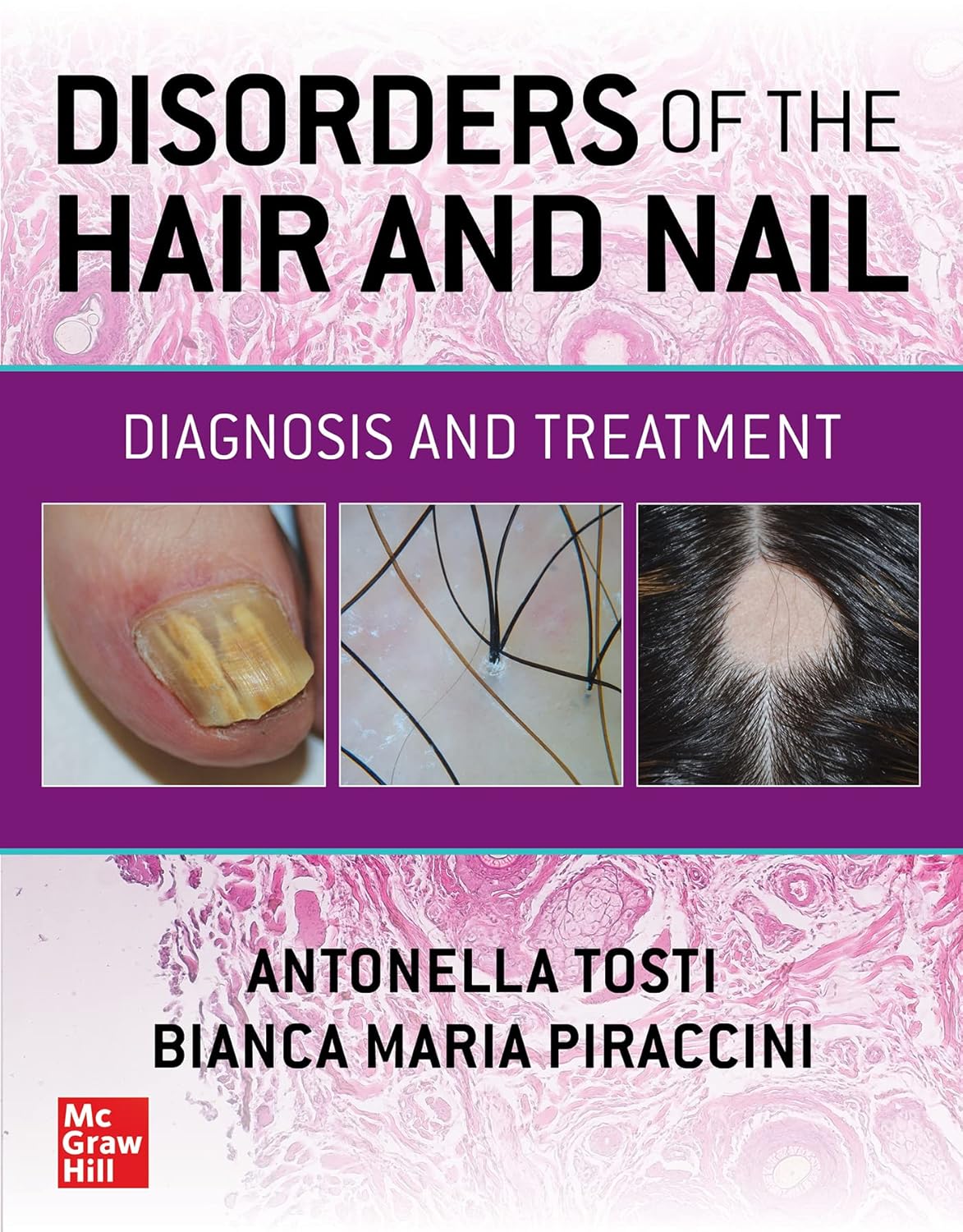 Disorders Of The Hair And Nail Diagnosis And Treatment (Hb 2024)